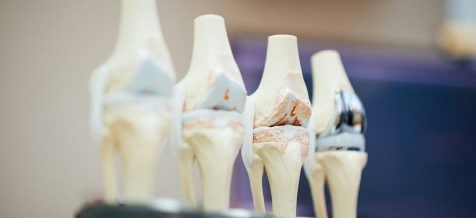 Fisioterapia a domicilio tras una prótesis de rodilla: Claves para una recuperación exitosa.