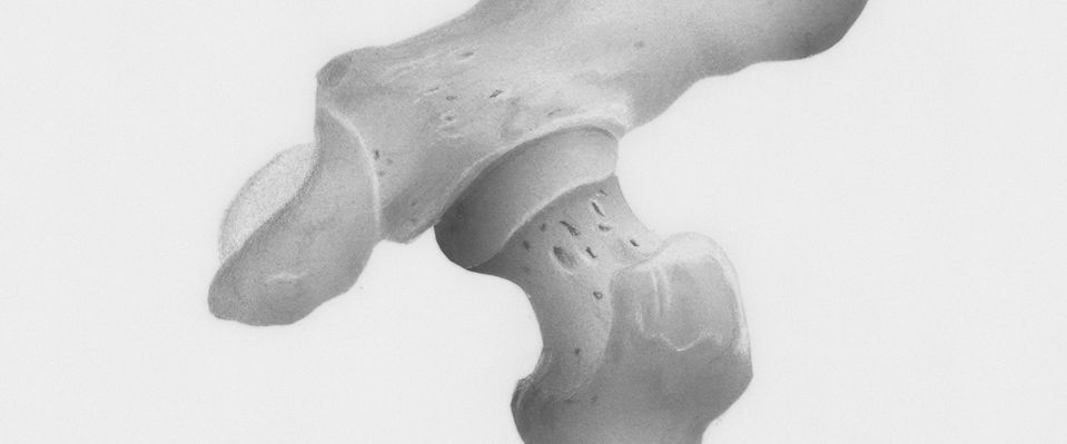 Fisioterapia Domicilio Artrosis Cadera.